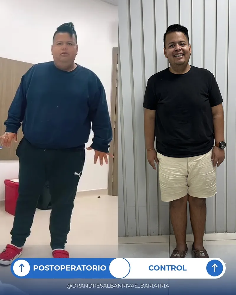 Antes y después de manga gástrica, paciente D. J.