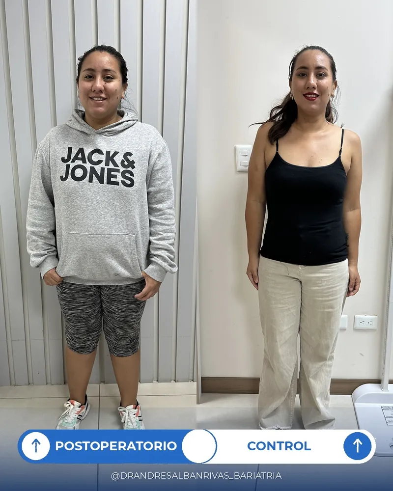 Antes y después de manga gástrica, paciente G. L.