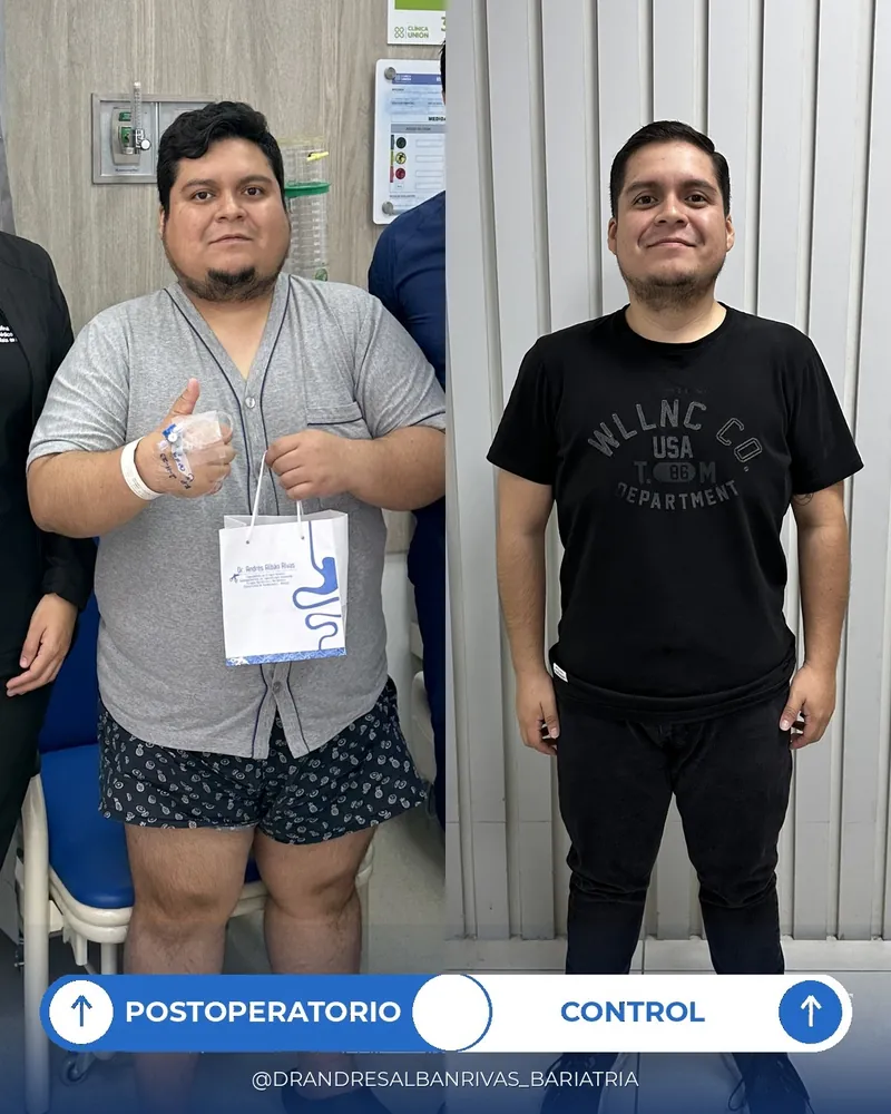 Antes y después de manga gástrica, paciente W. M.