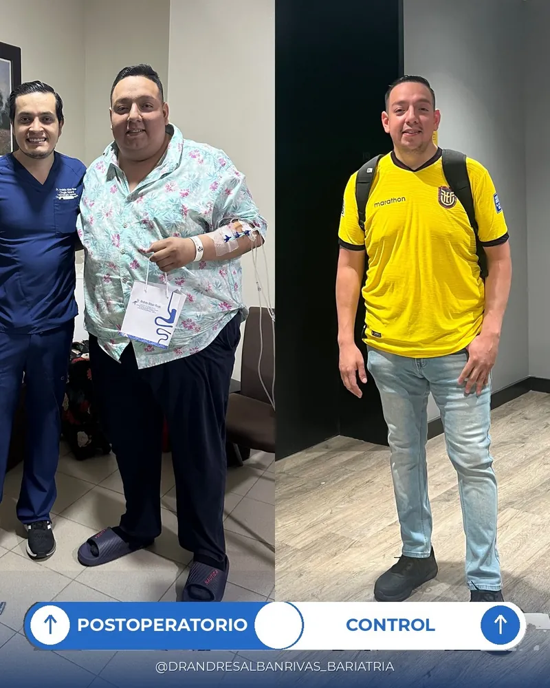 Antes y después de manga gástrica, paciente A. C.