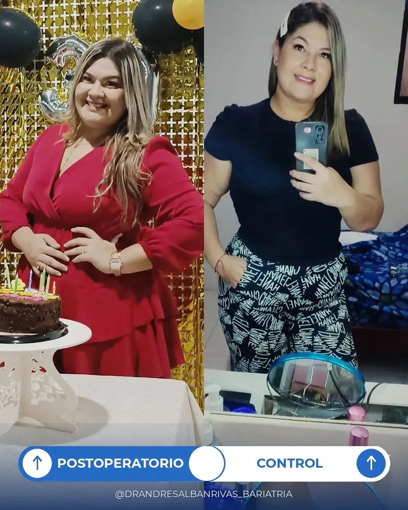 Antes y después de manga gástrica, paciente K. C.