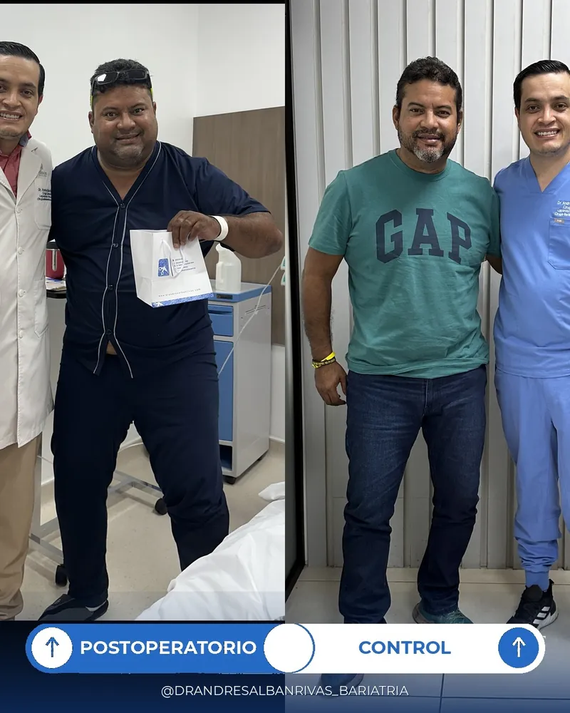 Antes y después de manga gástrica, paciente L. M.