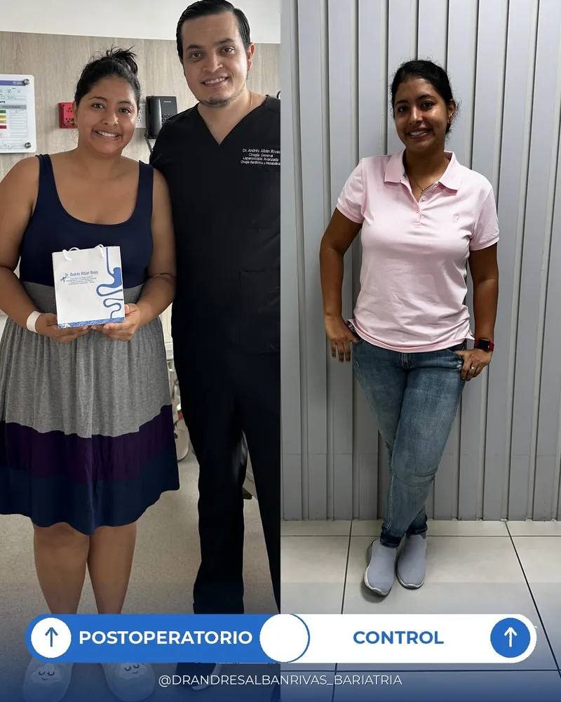 Antes y después de manga gástrica, paciente K. S.