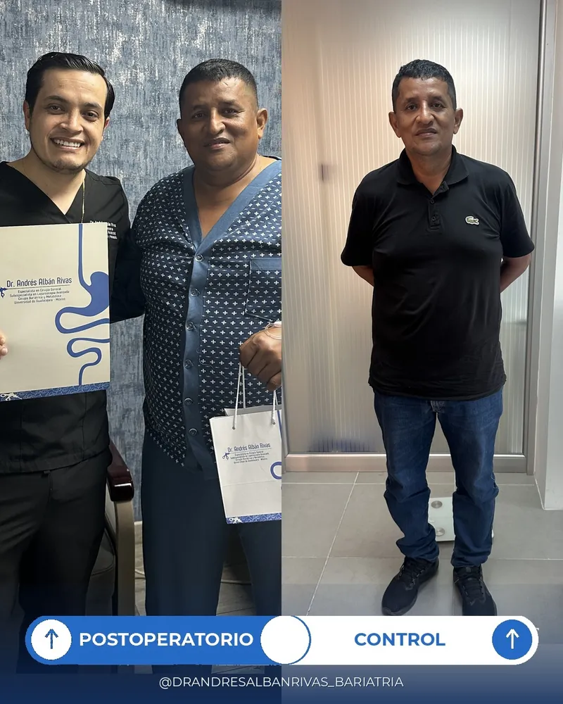 Antes y después de manga gástrica, paciente C. V.