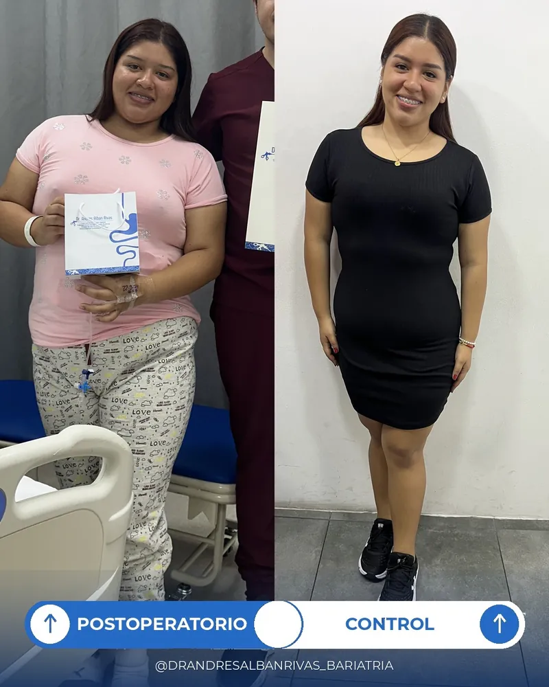 Antes y después de manga gástrica, paciente R. M.