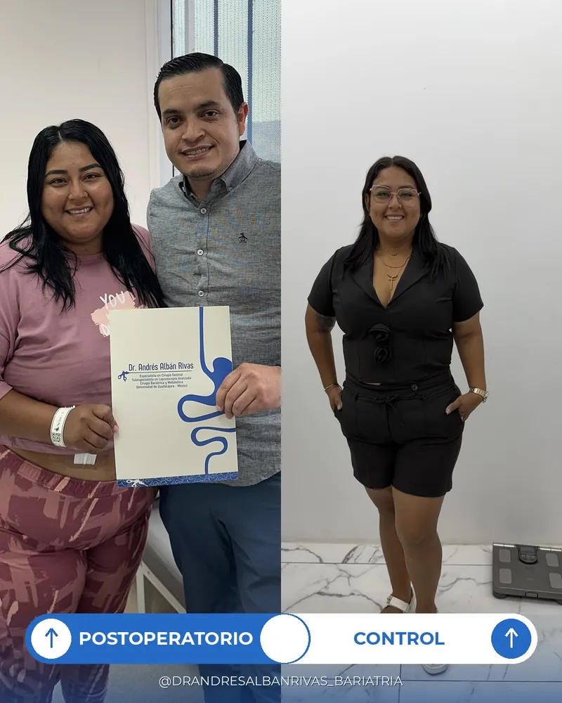 Antes y después de manga gástrica, paciente A. A.