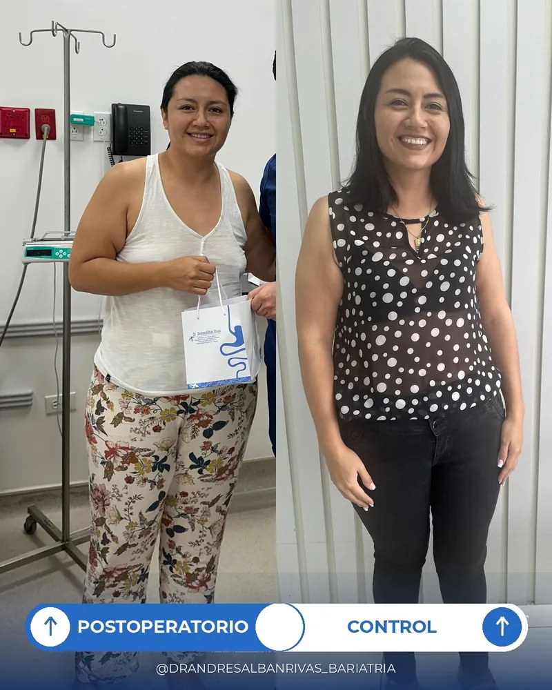 Antes y después de manga gástrica, paciente X. C.